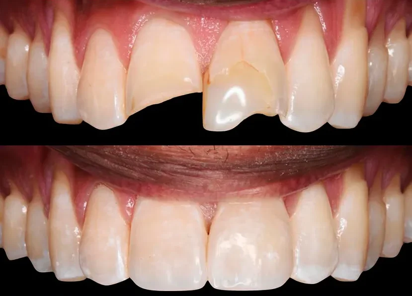 reconstruccion-dental-antes-y-despues.jpg